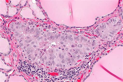 Papillary Thyroid Carcinoma Libre Pathology