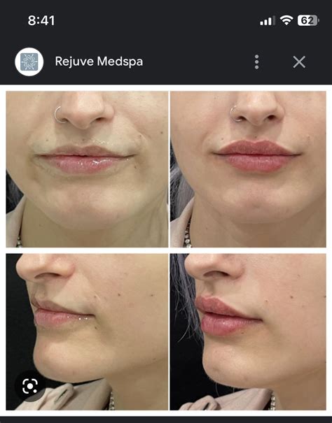 Lip Injection Before After Gallery Artofit