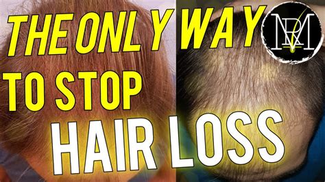 How To Stop Hairloss Proven Hair Loss Remedies Youtube