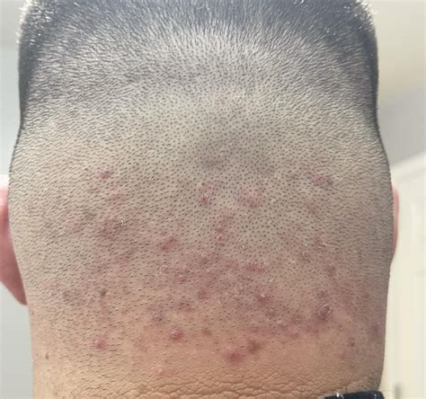 Is This Folliculitis? : r/Folliculitis