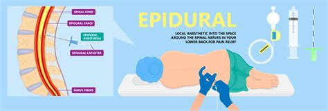 Lumbar Epidural Steroid Injections What It Is Benefits