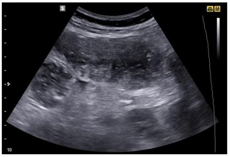 Can You See Intestines In Ultrasound at Joanne Tindall blog