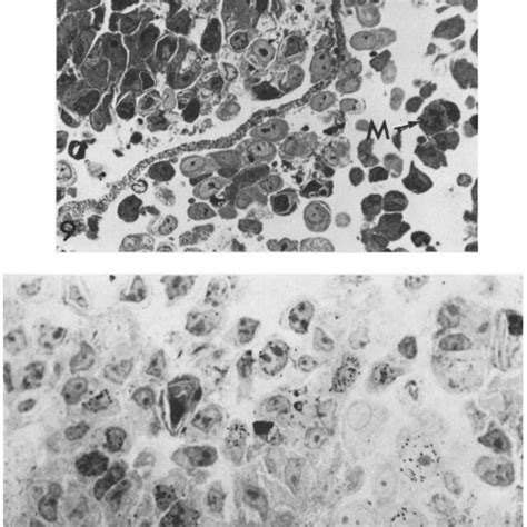 Z Thick Epon Section Of Tumor Ceils From The Periphery Of An