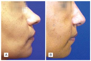 RBCP Surgical Treatment Of Retracted Columella In Primary Noses