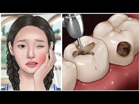 ASMR Impacted Wisdom Tooth Extraction Removal Dental Care Animation