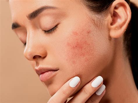 Arriba 52 Imagen Recetas Caseras Para El Acne Con Sabila Abzlocal Mx