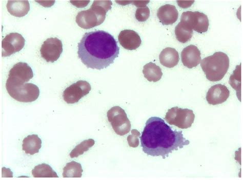 Plasma Cells With Hairy Projections And Auer Rod Like Inclusions In A