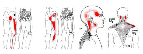 What Is Trigger Point Therapy