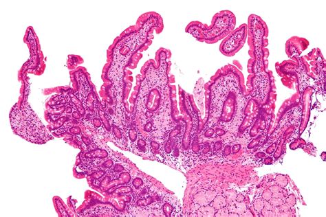 Whipple disease - Symptoms, Diagnosis and Treatment - Costamedic