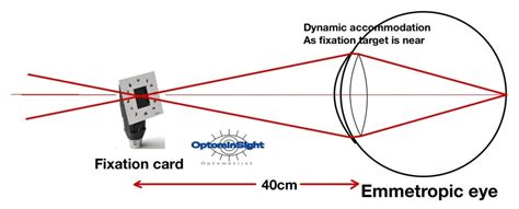 Types of retinoscopy - OptomInSight