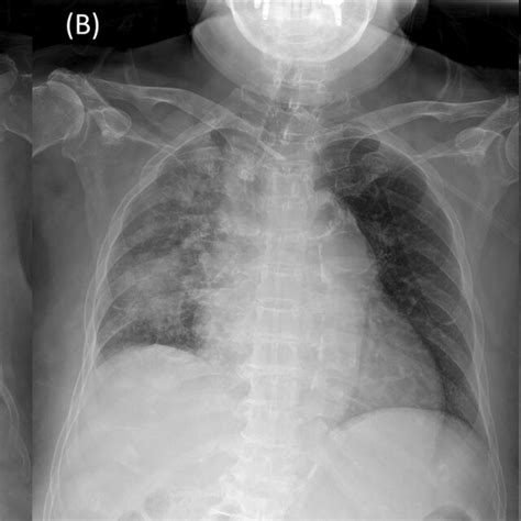 The Serial Chest Radiographs Taken After Initiation Of Treatment A