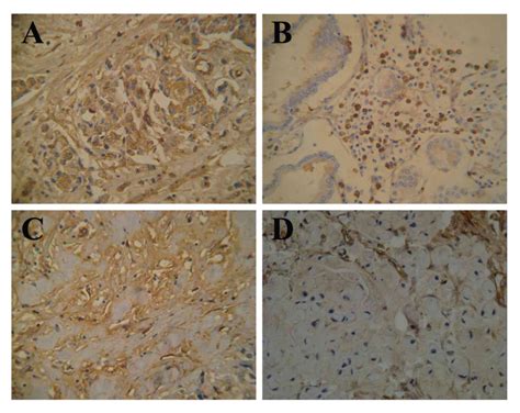 Lumican Expression In Gastric Cancer And Its Association With