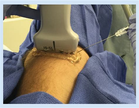 Figure 1 From Ultrasound Guided Interventional Procedures For Chronic