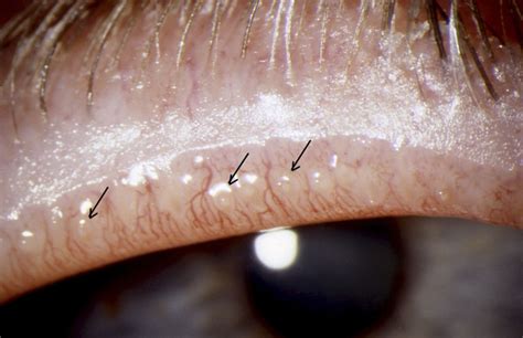 Meibomian Gland Diagram