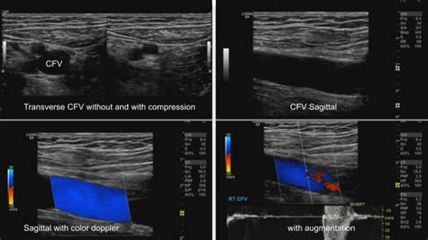 Lower Extremity Venous Duplex Protocol Sonographic Tendencies