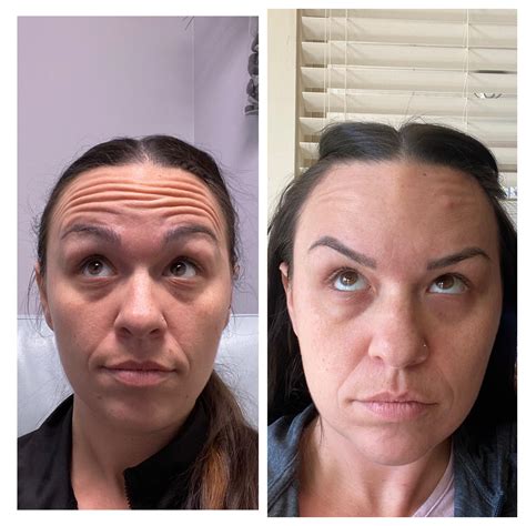 First Time Botox First Round Was 30 Units Nov 21 Second Round Totaling 52 Units Dec 6 And I