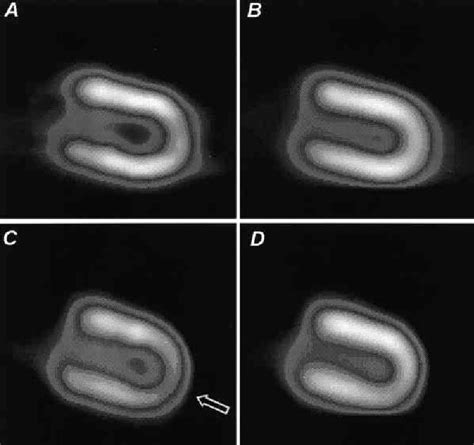 Figure From Artifactual Reverse Distribution Pattern In Myocardial