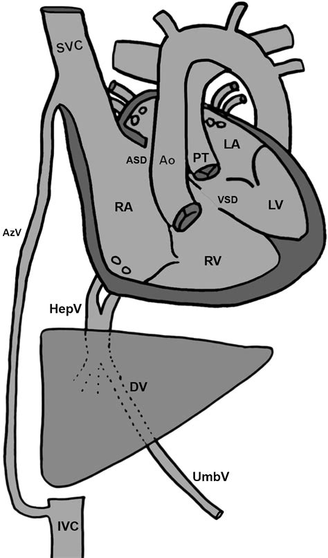 Transposition Of The Great Arteries Interrupted Inferior Vena Cava And