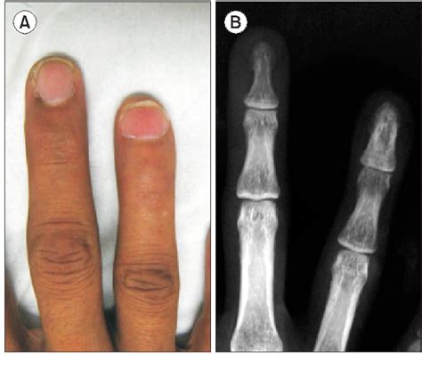 Osteoid Osteoma Of The Distal Phalanx Of The Ring Finger With Clubbed