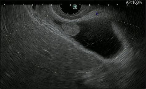 Figure Fundamental B Mode Eus For Gallbladder Polypoid Lesions