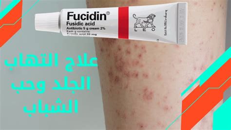 كريم مضاد حيوي لعلاج التهابات الجلد وحب الشباب Fucidin Cream كريم