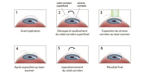 Lasik Tunisie Chirurgie Correction Vue Au Laser