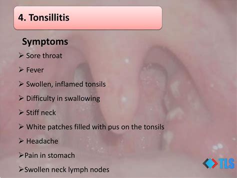 White Spots On Tonsils Treatment