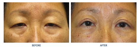 Eyelid Ptosis Repair Palm Beach Gardens Jupiter FL OOC