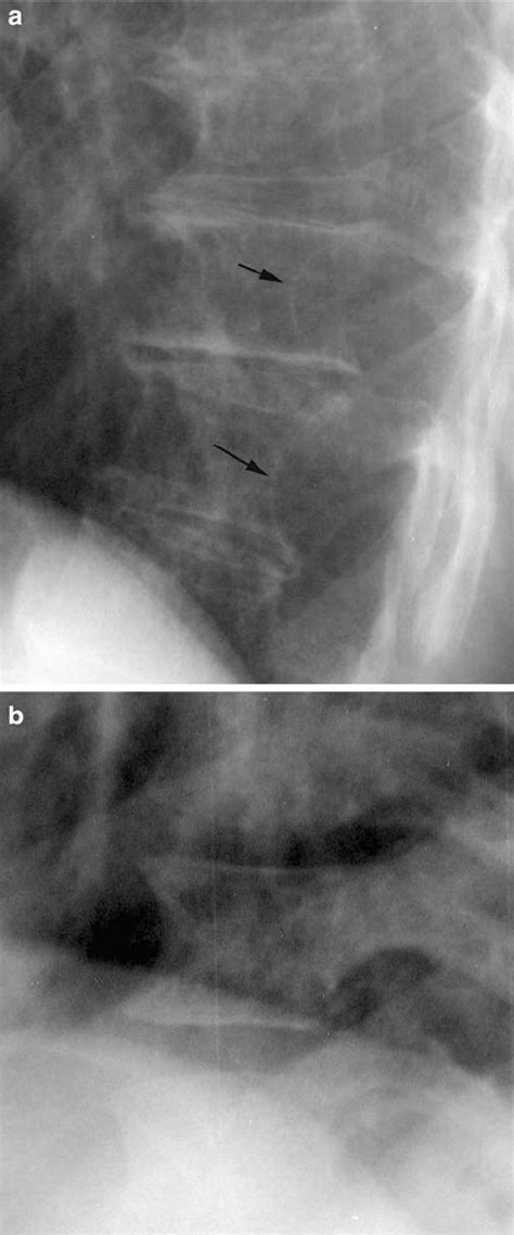 Ap Radiograph Of The Upper Chest Wall Demonstrating Rib Pencilling