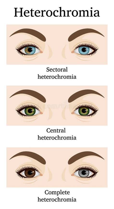 Illustration of Heterochromia Iridum Stock Vector - Illustration of medical, complete: 173725037