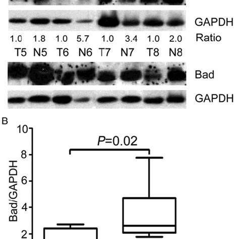 Expression Of Bad Was Decreased In Hcc Tissues By Ihc Representative