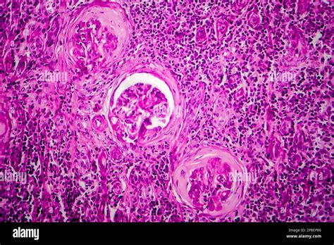 Renal Impairment Hi Res Stock Photography And Images Alamy