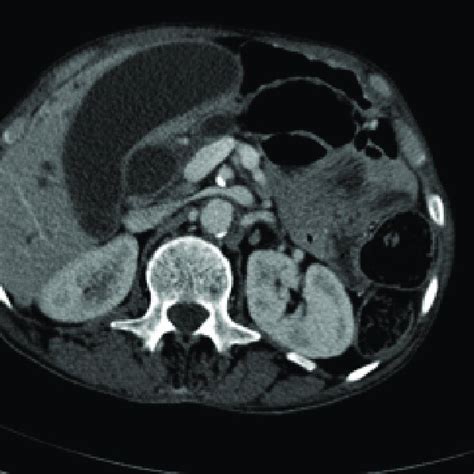 Axial Contrast Enhanced Computed Tomography Demonstrating Hydroipc Download Scientific Diagram