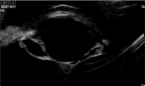 Ultrasound Biomicroscopy Of The Right Eye Showing Angle And Ciliary