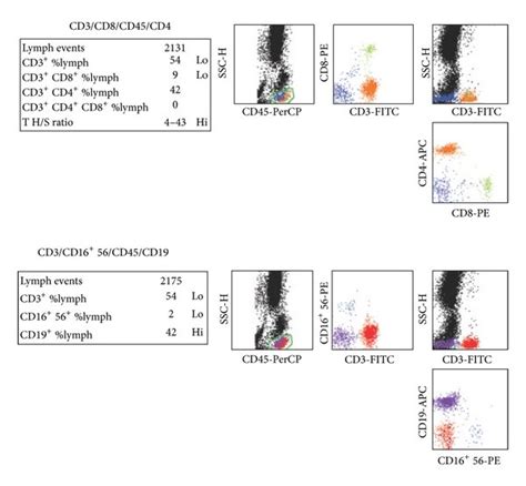 The cervical lymph node excisional biopsy revealed a lymphohistiocytic ...