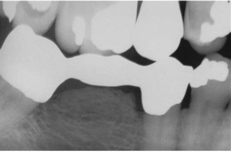 Reactive Subpontine Exostosis MEDizzy