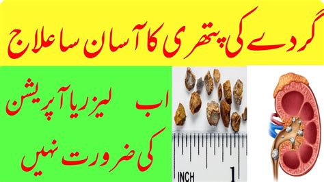 Gurday Ki Pathri Ka Ilaj In Urdu Kidney Stone Treatment Gurde Ki Dard