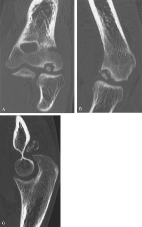 Osteochondritis Dissecans | Musculoskeletal Key