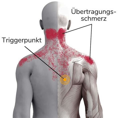 Schmerzen Durch Triggerpunkte Das Musst Du Unbedingt Wissen