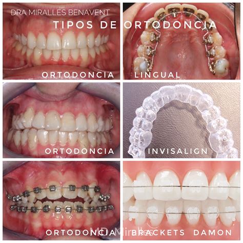 Tipos de Ortodoncia CLÍNICA DENTAL DOCTORA MIRALLES