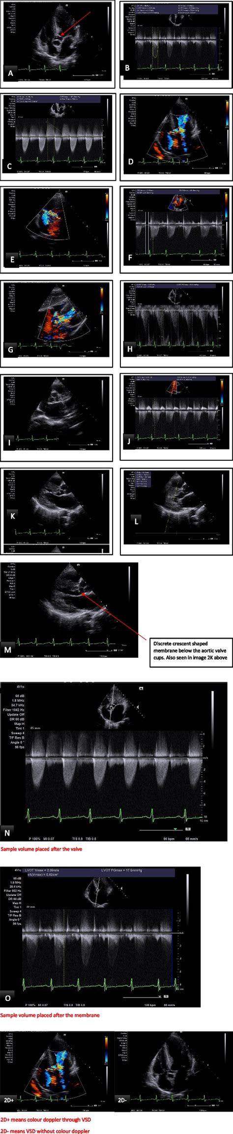 A Apical 5 Chamber View Of Sub Aortic Membrane Red Arrow B Spectral Download Scientific