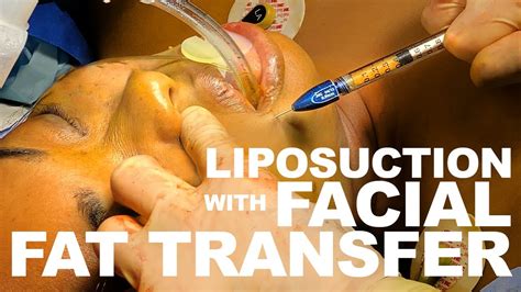 Liposuction With Facial Fat Transfer Dr Paul Ruff West End Plastic Surgery Youtube