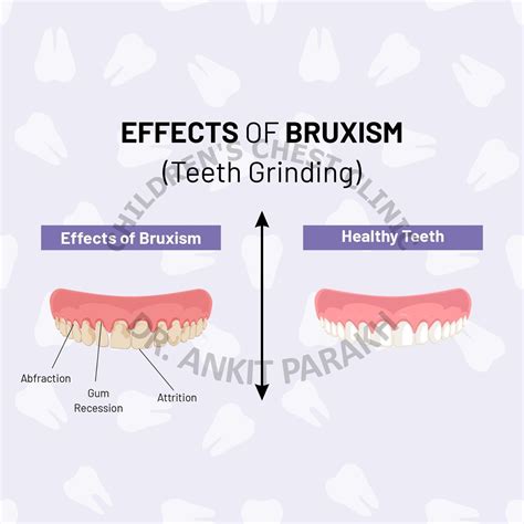 Is Teeth Grinding A Sign Of Autism 2