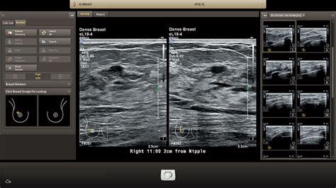 Anatomical Intelligence For Breast Philips Healthcare