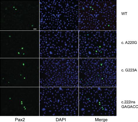 Figure 1 From Papillorenal Syndrome Causing Missense Mutations In PAX2