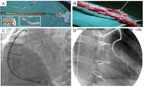 Unsupported And Supported Saphenous Vein Sv Grafts For Coronary