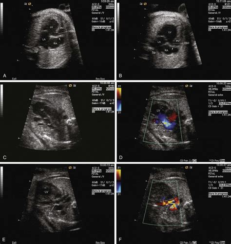 Tricuspid Atresia Radiology Key