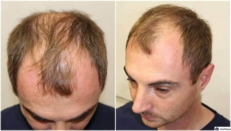 Two Hair Transplants A Complete Success Alexs Hair Restoration A Z