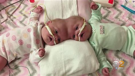 Formerly Conjoined Twins Now Thriving Following High Tech Surgery Youtube