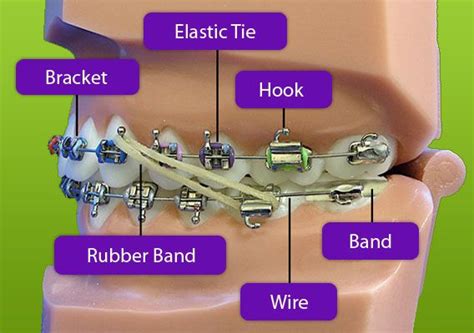 You Know That How Do Braces Work Better Braces Braces Brace Face